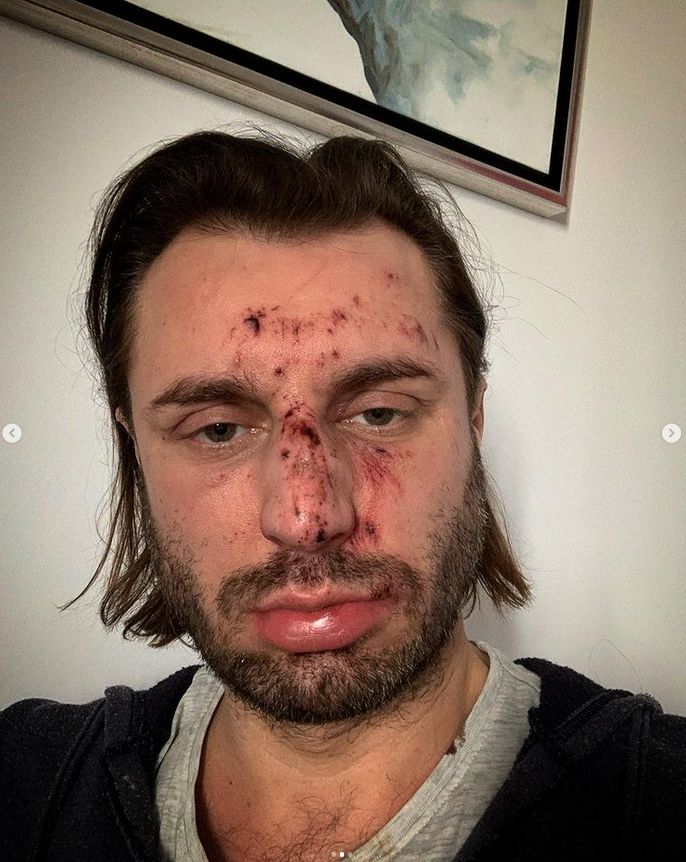 Rafał Grabias został pobity i okradziony