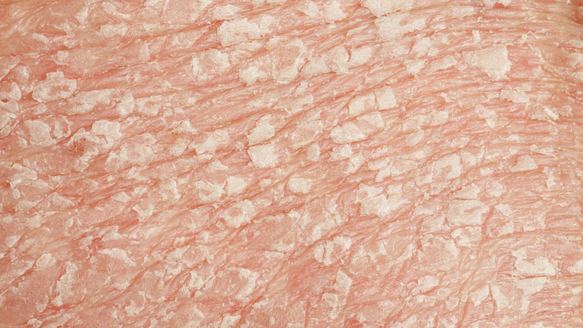 Łuszczyca to choroba skóry o przewlekłym przebiegu