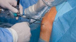 Rewizyjna rekonstrukcja więzadła krzyżowego przedniego kolana 