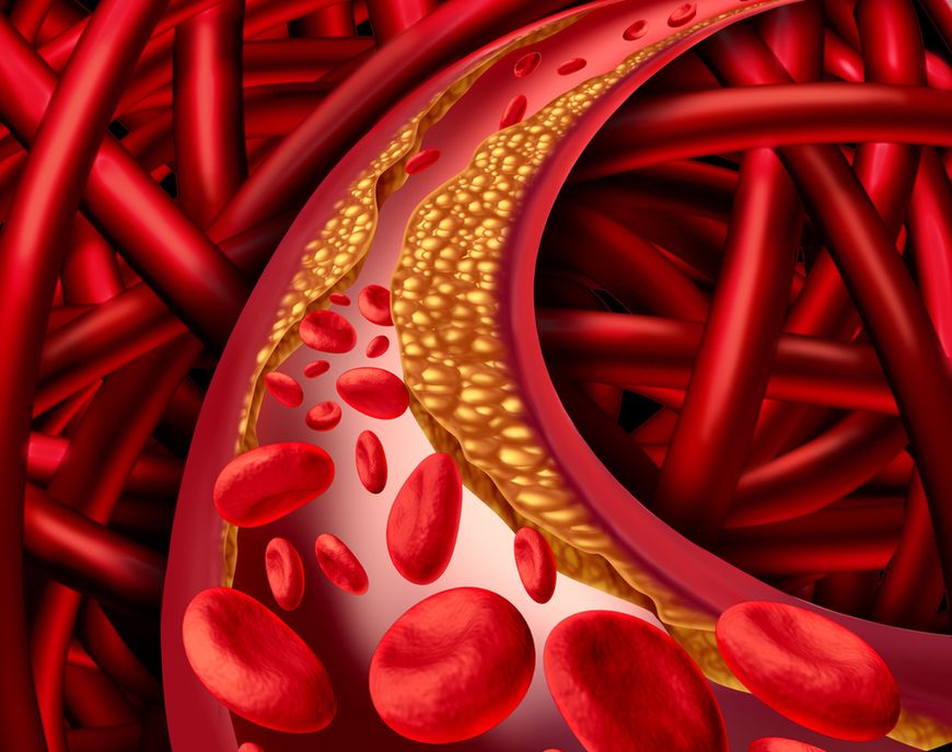 Zwiększenie stężenia złego cholesterolu powoduje powstawanie blaszki miażdżycowej