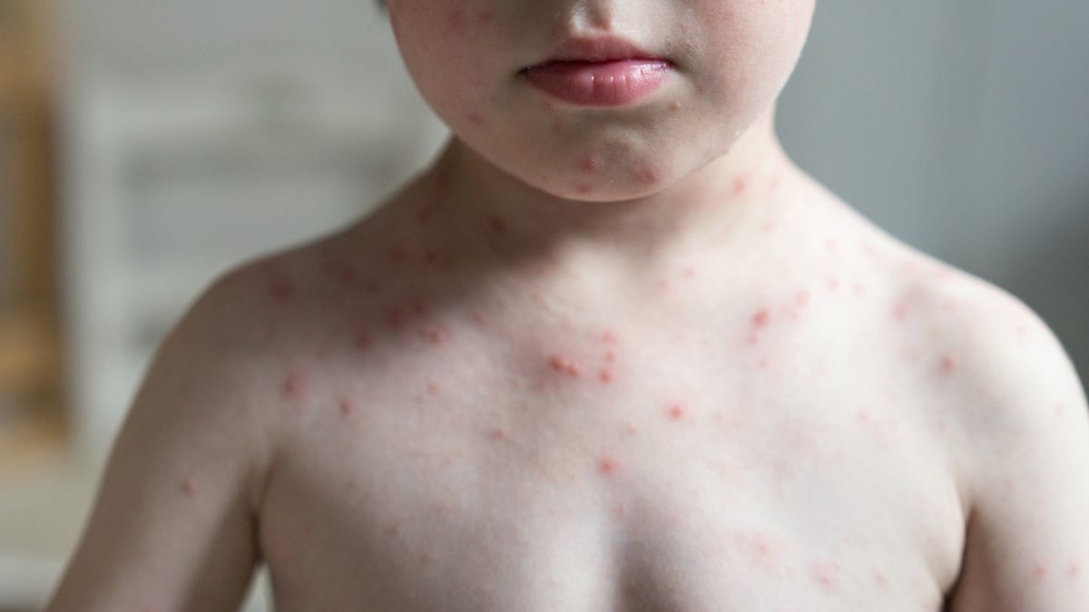 Wysypka jest jednym z głównych objawów nowej przypadłości