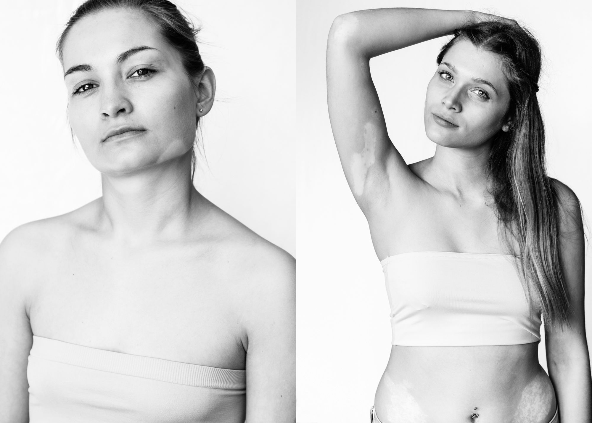 Julia Kaczorowska pokazuje, jak wyglądają „WZORY” na ciele osób z bielactwem 3