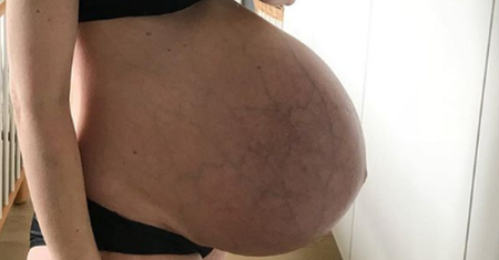 Brzuch po urodzeniu trojaczków. Mama pokazała zdjęcie bez retuszu