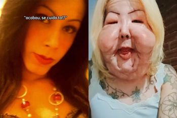 Chciała poprawić twarz. Tak wygląda po nieudanej operacji