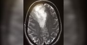 W jej głowie rozwijał się guz mózgu