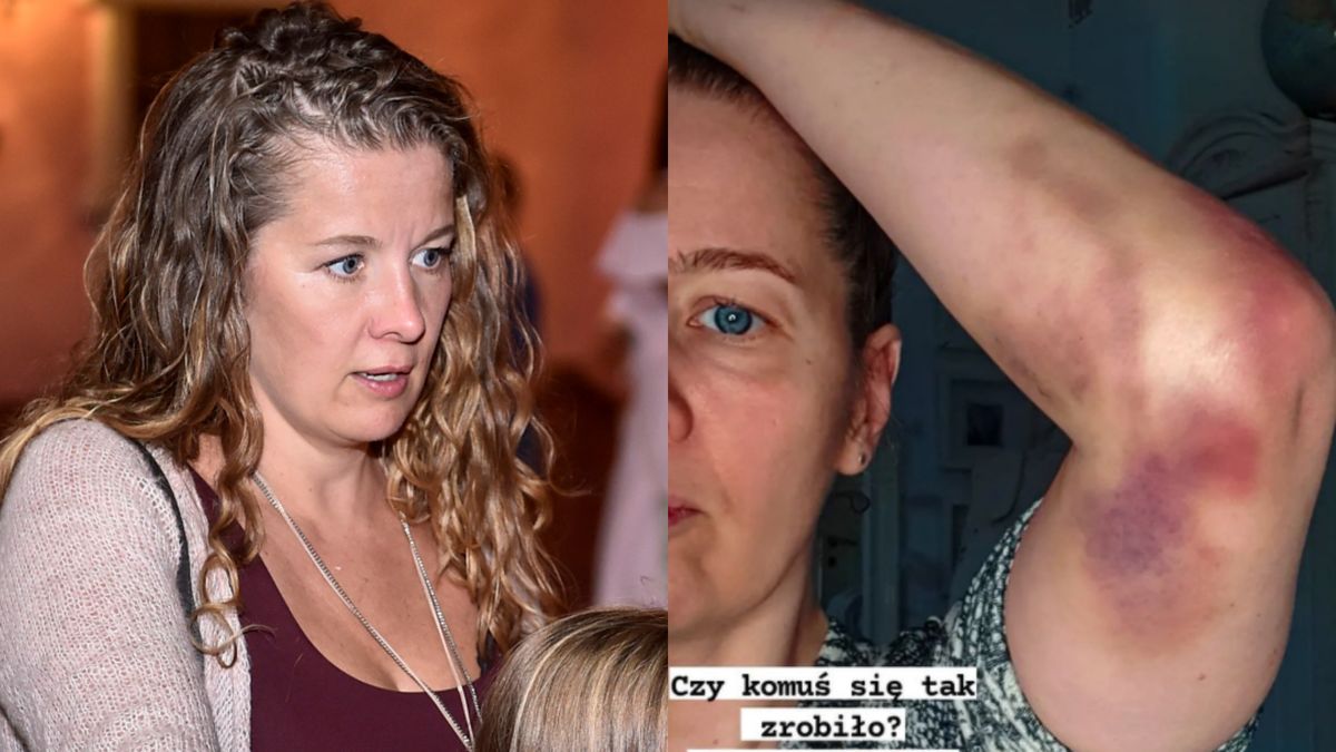 Anna Powierza pokazała posiniaczoną rękę 