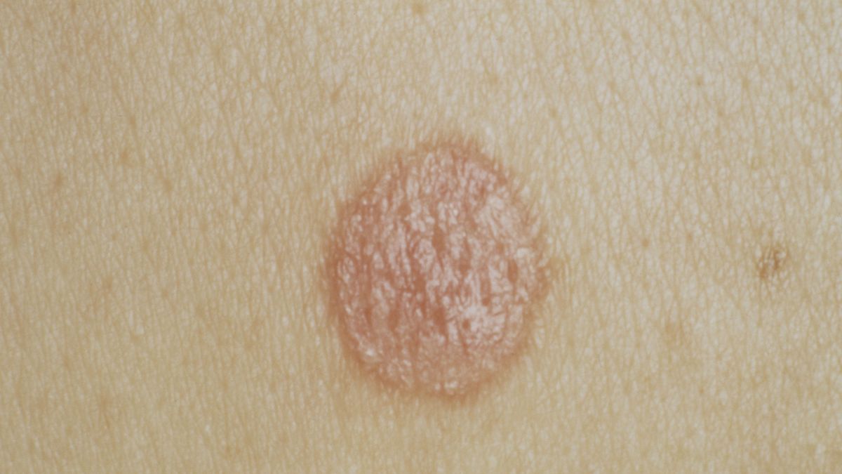 Psoriasis
Psoriasis (Photo By BSIP/UIG Via Getty Images)
BSIP
adult, close up, dermatology, dermatosis, human, medicine, person, psoriasis, skin