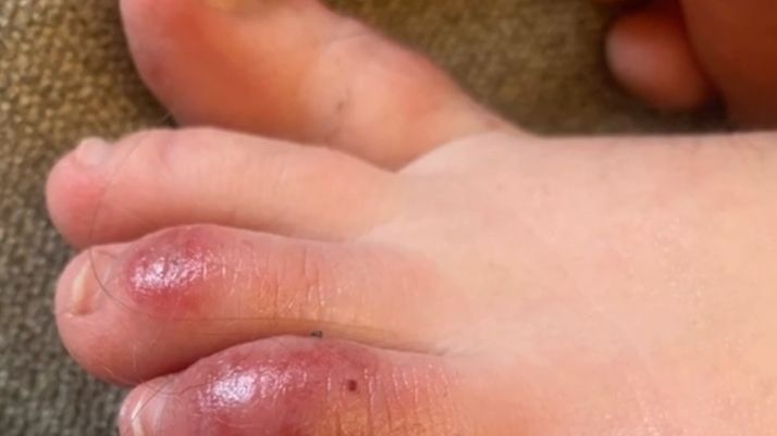 Covidowe palce mogą być jednym z nietypowych objawów zakażenia koronawirusem