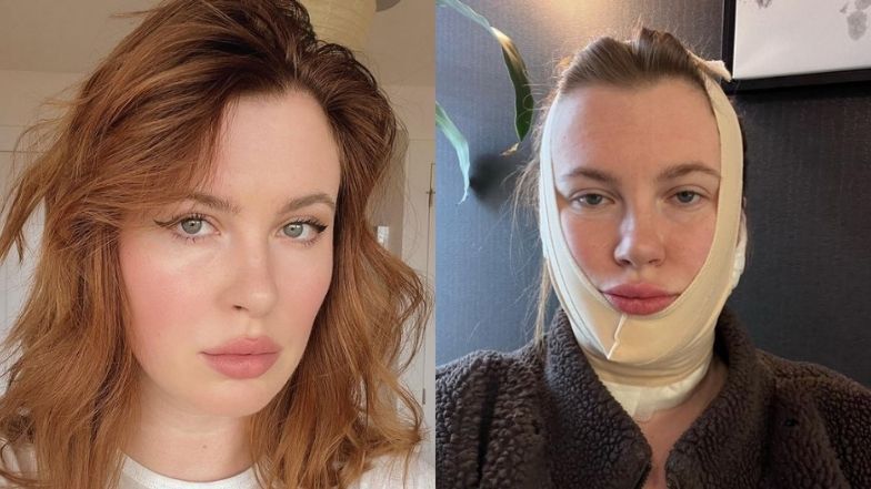 Ireland Baldwin tłumaczy się z zabiegu podbródka