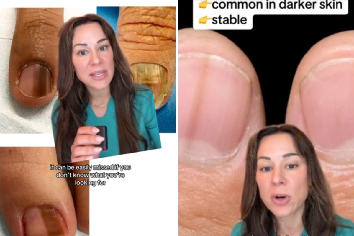 Dermatolog wskazuje objaw raka widoczny na paznokciach