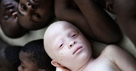 Wyjątkowe zdjęcia albinosów pomagają zwrócić uwagę na ich trudną sytuację w Tanzanii