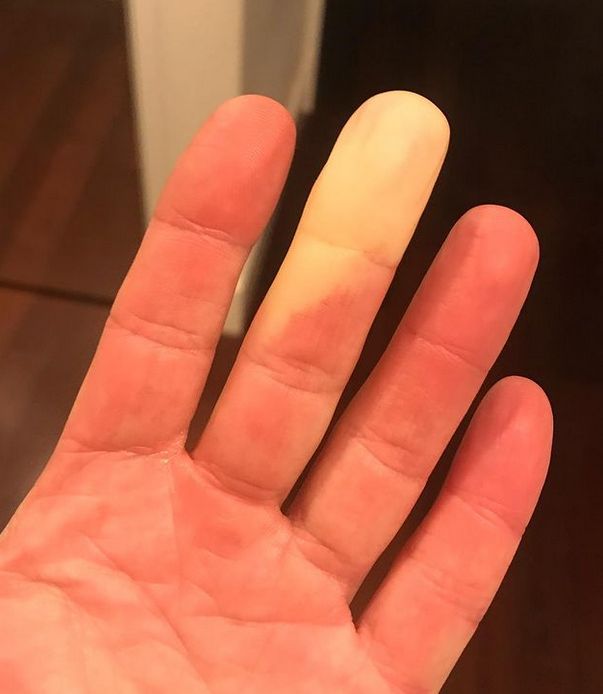 Nagłe blednięcie palców powinno wzbudzić niepokój