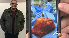 Myślał, że to brzuch piwny. Okazało się, że to wielki guz