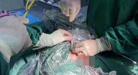 Dziesięciolatek z kablem w pęcherzu. Lekarze usunęli obce ciało dopiero po pięciu latach