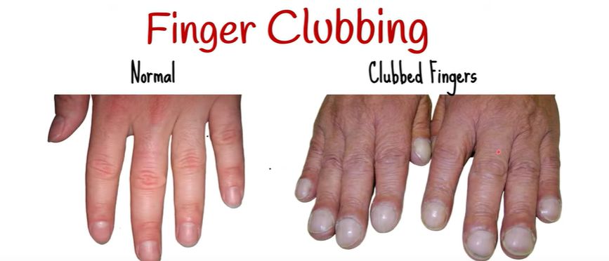 Palce pałeczkowate - potencjalny objaw nowotworu płuca