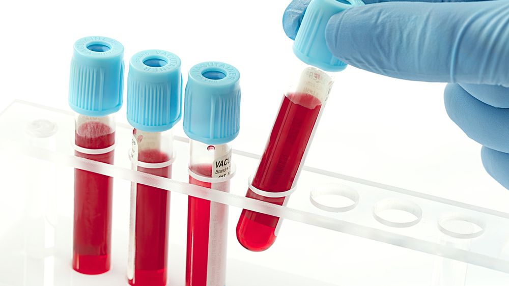 Podwyższone OB w badaniu krwi może świadczyć o stanie zapalnym w organizmie