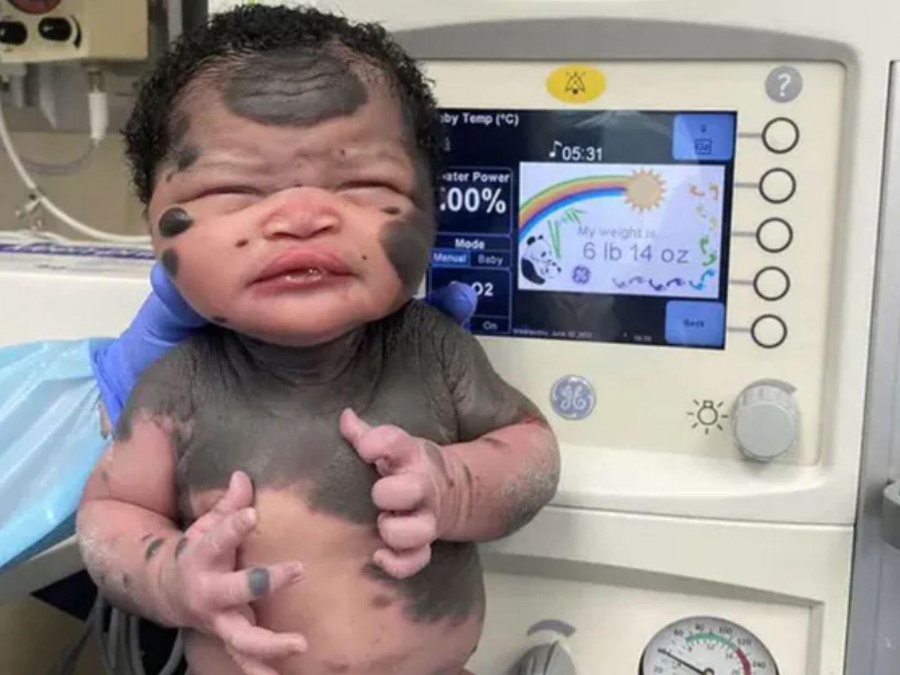 Jej narodziny były zaskoczeniem. Tak dzisiaj wygląda słynna "dziewczynka-panda"