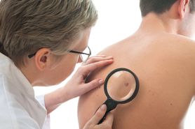 6 zaskakujących czynników, powodujących raka skóry