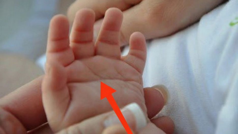 Może wskazywać na zespół Downa. Wiele chorych osób ma ją na dłoni
