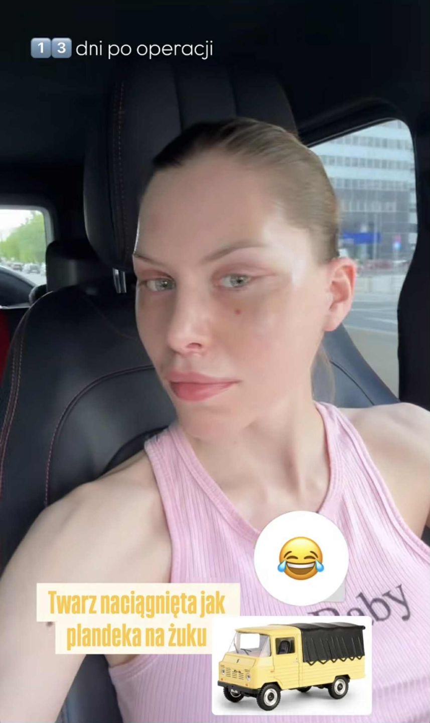 Julia von Stein pokazała zliftingowaną twarz 13 dni po operacji