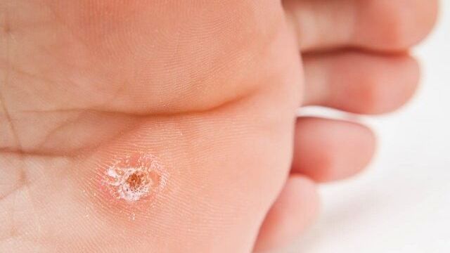Person with callus located under foot, close to toes towards white
Arve Bettum
background, body, callosity, callous, callus, copy, cosmetic, dermatology, detail, dry, female, foot, hard, heal, health, hyperkeratosis, isolated, isolation, male, man, part, skin, spa, space, texture, thickening, toe, treatment, under, wart, wellness, white, woman