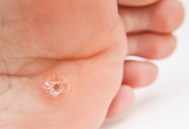 Brodawki, kurzajki i wirus HPV – co powinieneś wiedzieć?