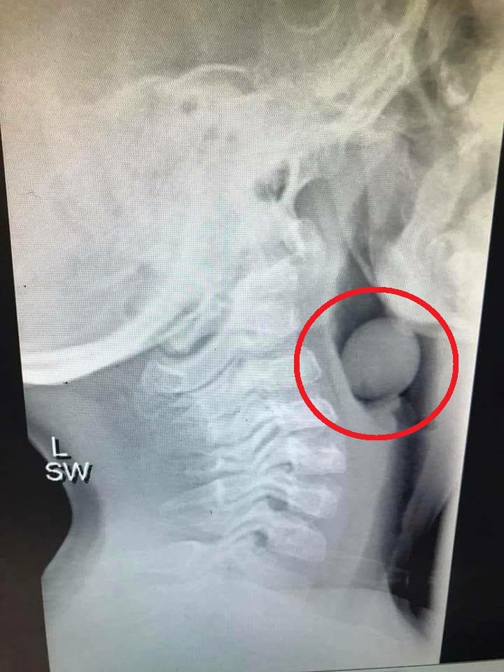 Zdjęcie RTG pięcoletniego chłopca