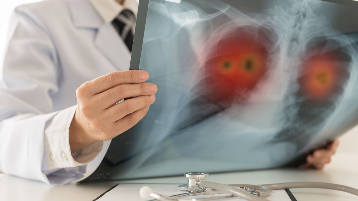 Guz Pancoasta to rodzaj nowotworu płuca umiejscowionego w jego górnej części