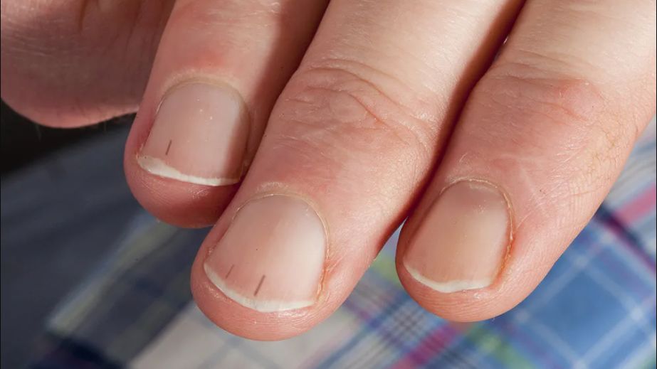 Czerniak podpaznokciowy