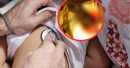 4-latkę bolał brzuch. Szokujące, co znaleźli w jej żołądku