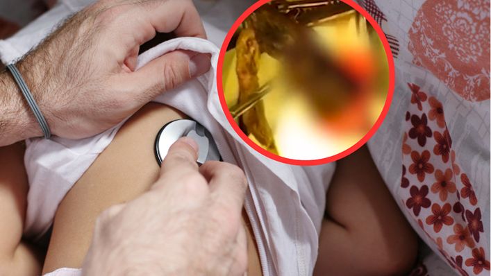 Syndrom Roszpunki. Lekarze znaleźli to w żołądku 4-letniej dziewczynki