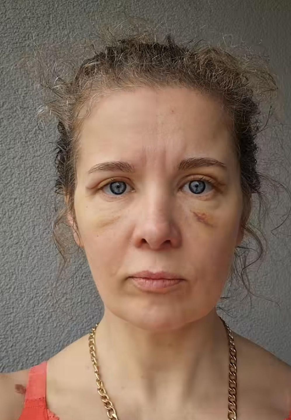 Anna Powierza wycięła nadmiar skóry na powiekach