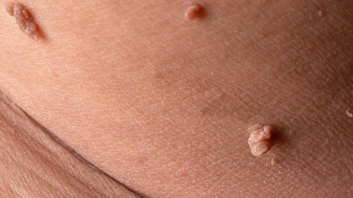 Vericaust zawiera silnie żrący kwas chlorooctowy.