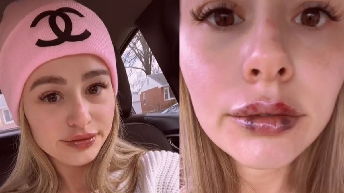 Powiększyła sobie usta. To, co stało się po zabiegu, przeraża