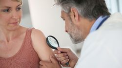 Kaszak - przyczyny, objawy, rozpoznanie, leczenie, domowe sposoby