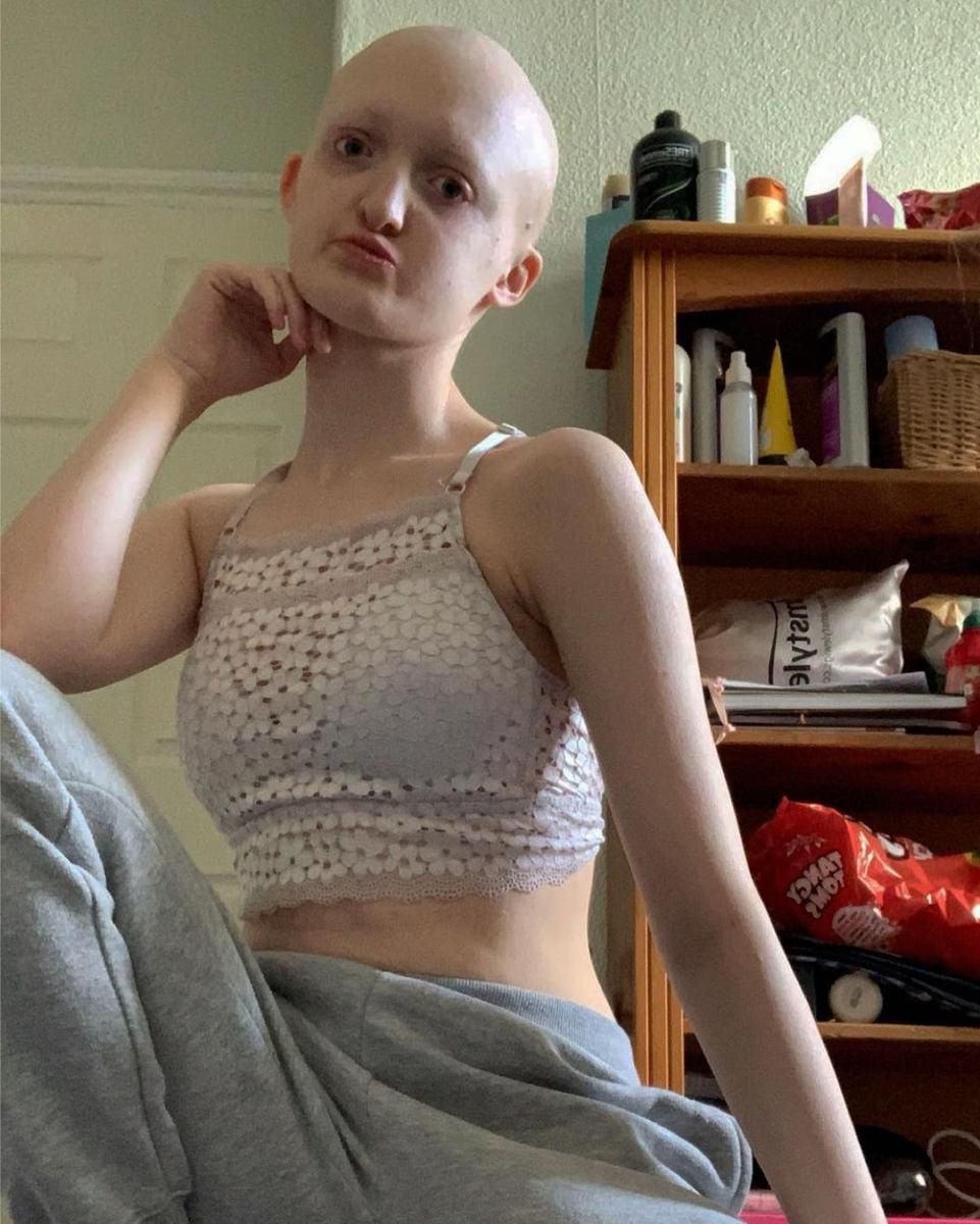 Hannah cierpi na rzadkie schorzenie