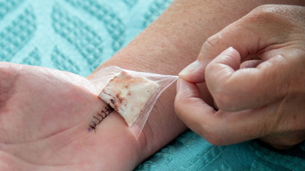 Operacja cieśni nadgarstka pozwala na odbarczeniu nerwu pośrodkowego w kanale nadgarstka