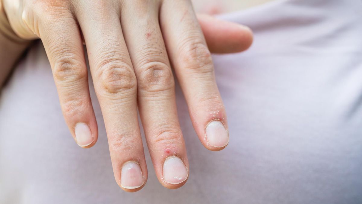 O czym świadczą zmiany na paznokciach?