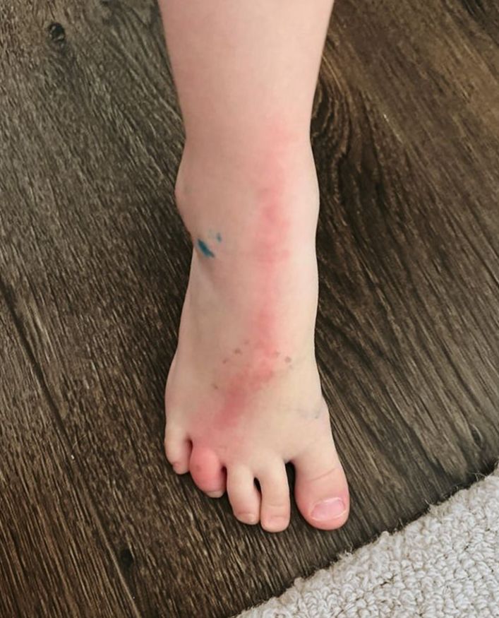 Czerwona pręga może wskazywać na zapalenie naczyń chłonnych