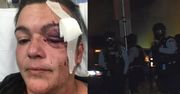 Fotografka straciła wzrok w zamieszkach. Złożyła pozew przeciw policji
