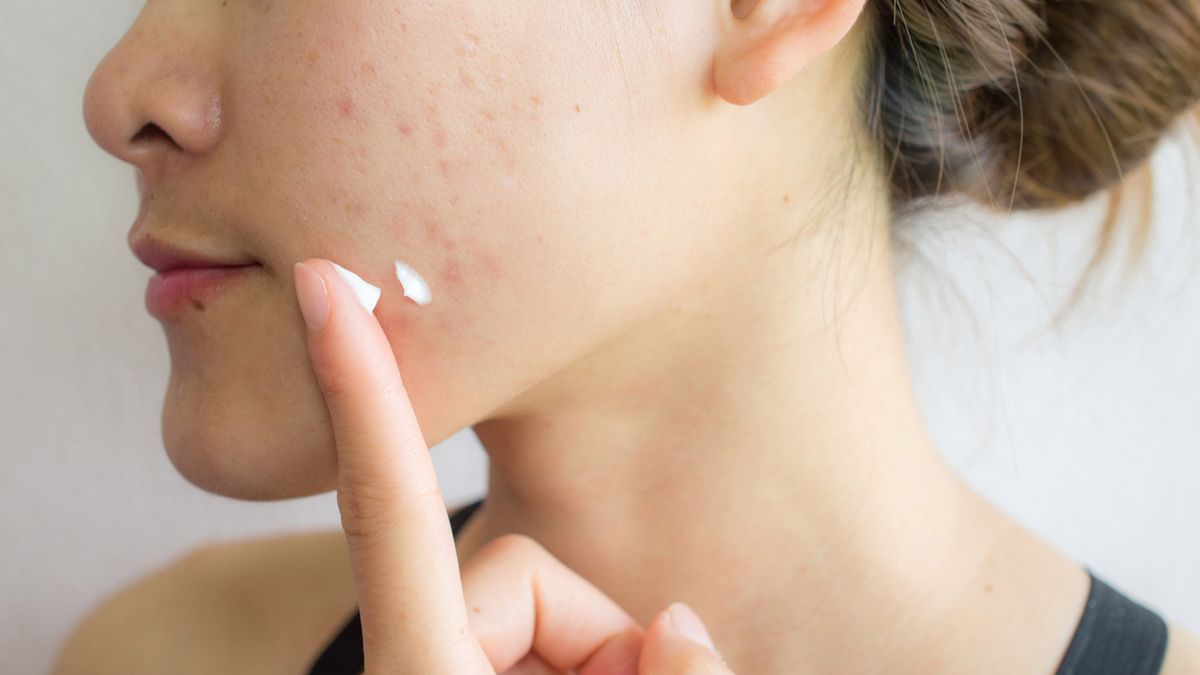 Zaskórnikami nazywamy drobne, białe bądź czarne krostki zlokalizowane tuż przy ujściu mieszków włosowych