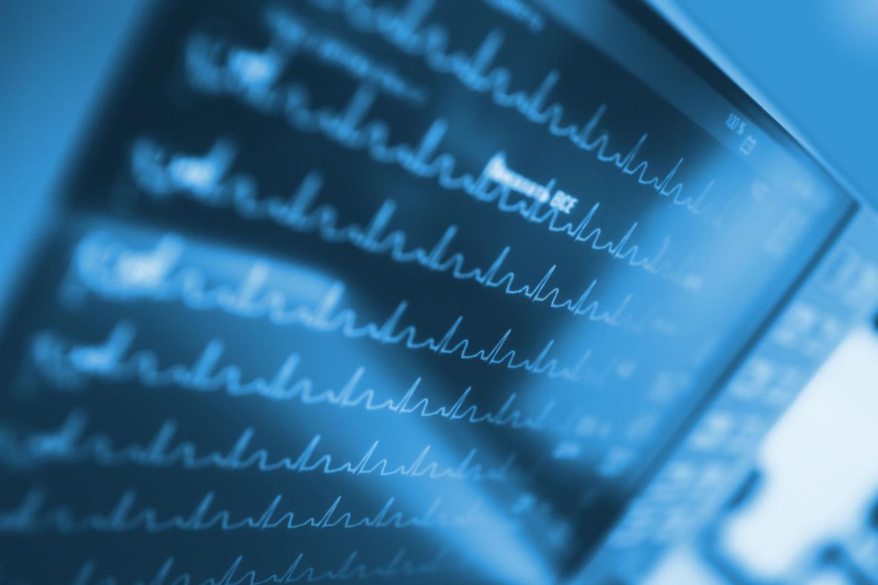 Migotanie komór – objawy, przyczyny i pierwsza pomoc