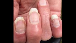  Covidowe paznokcie. Coraz częstszy objaw u zakażonych koronawirusem