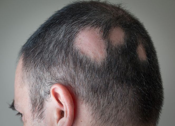 Podstawową metoda leczenia łysienia plackowatego jest przyjmowanie kortykosteroidów, które podwajają produkcję hormonu przez gruczoły nadnerczy.