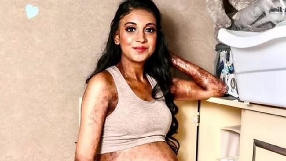 Shirvani Naran cierpi na wrodzone pęcherzowe oddzielanie się naskórka