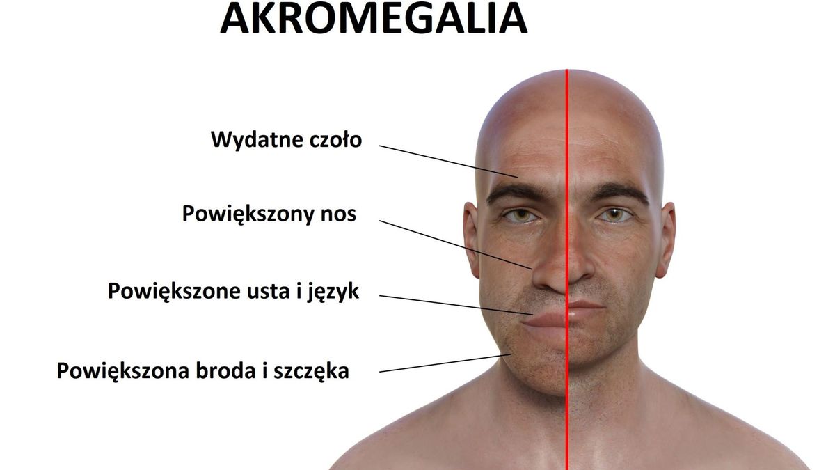 Gigantyzm, poza wysokim wzrostem, objawia się także powiększeniem i pogrubieniem kości, chrząstek i tkanki łącznej. Widać wyraźnie zarysowaną szczękę i pogrubienie rysów twarzy.
