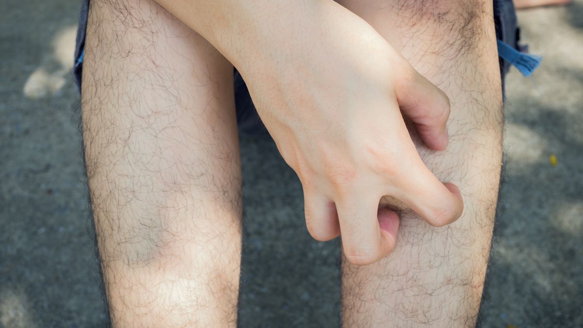 Rogowacenie słoneczne jest zmianą przednowotworową.