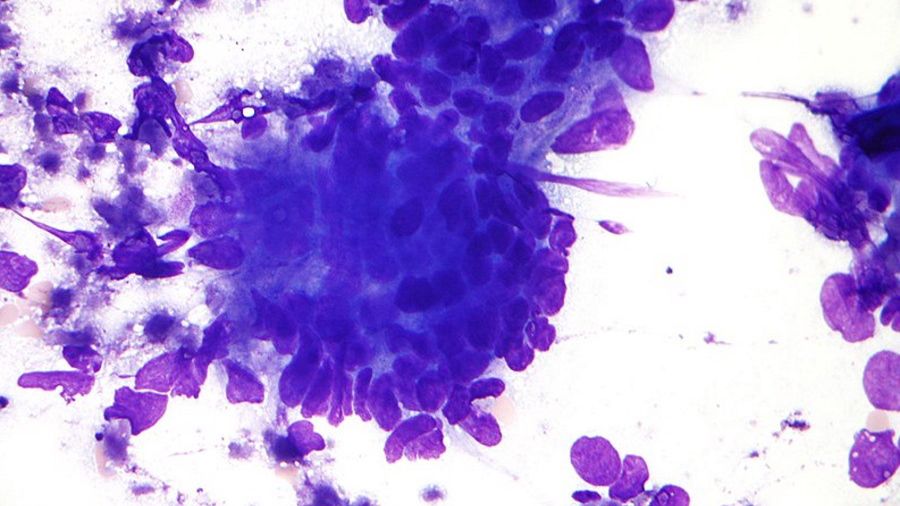 Gruczolakorak jelita grubego