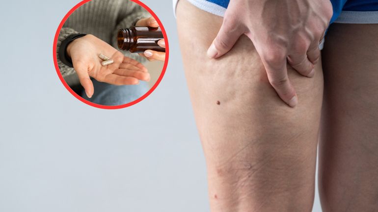 Suplementy na cellulit - które wybrać?