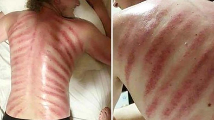 Zdecydował się na masaż, był w szoku, gdy rano zobaczył swoje plecy